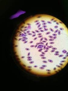 Leukocytosis